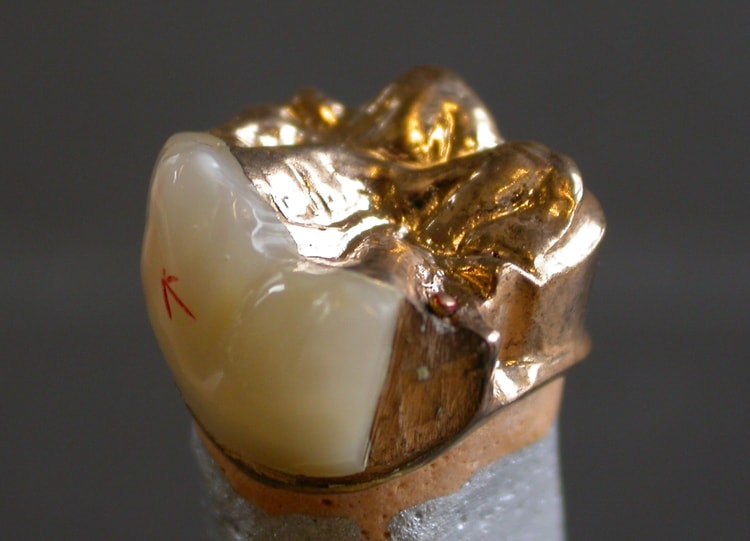 03_tooth_dental_crow_FQZVA.jpg